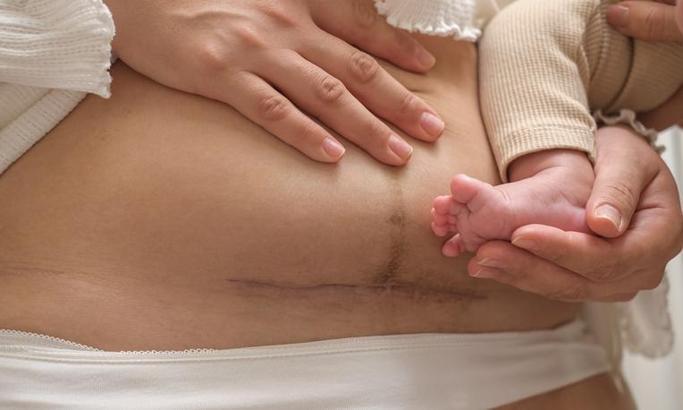 Sezaryen sonrası iz ihtimalini gözden sakın kaçırmayın!