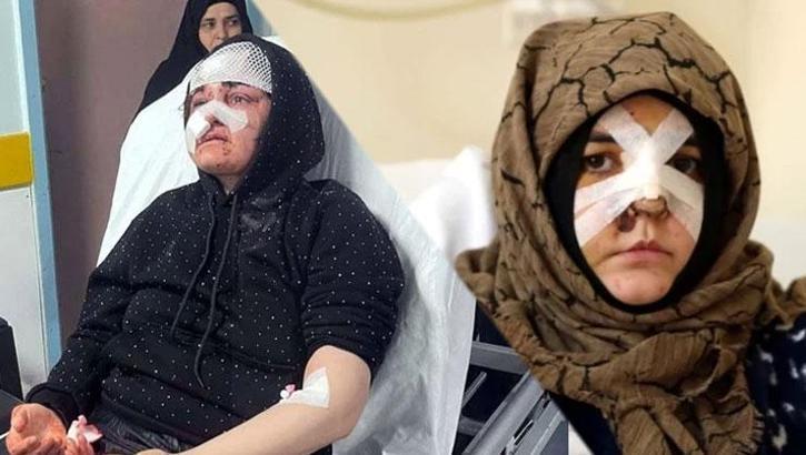 Kaldırım taşıyla saldırdı, Nazlı'nın kabusu oldu: Ayaklarımın üzerinde dursaydım ona dönmezdim