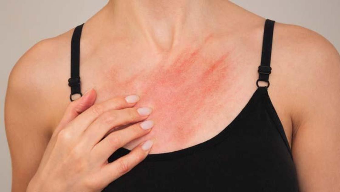 Türk Dermatoloji Derneği'nden şaşırtan açıklama: 3 yıl süren uyuz vakaları duyuyoruz