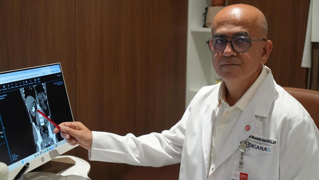 Böbreğinde 25 santimetreküplük taş çıkarıldı! Hiç ağrı hissetmeden yıllarca taşımış