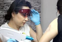 Polis olmak isteyenler dövmelerini sildiriyor