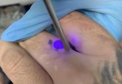 Lazerle dövme sildirme işlemi