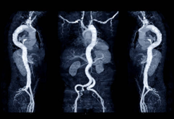 Beyinde patlamaya hazır bomba: Aort anevrizması nedir?