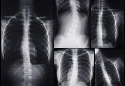 Çocuklarda ve ergenlerde skolyoz hiçbir belirti vermeden ilerliyor