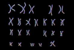 Edward sendromu kısaca nedir? Belirtileri nelerdir? Edward sendromu kromozom sayısı kaç?