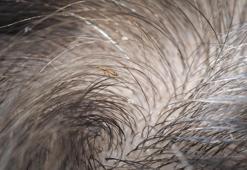 Saçta sirke ve bit neden olur, nasıl temizlenir? Saç sirkesi karşısında doğal çözümler...