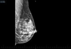 Aşılamaya bağlı lenf bezi tutulumu meme kanseriyle karıştırılıyor