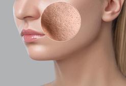 Gözenekli cilt nasıl düzelir? İşte gözenek sıkılaştırma yöntemleri