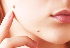 Et beni neden olur, neden çıkar? Kendiliğinden düşer mi? Koparmak tehlikeli mi?