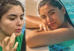 Hanife Gürdal dudaklarına dolgu yaptırdı