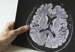 Kovid-19 zihinsel fonksiyonları geriletiyor