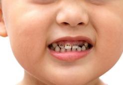 Bebeklerin ilk diş muayenesini ertelemeyin