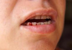 Ağızdan kan gelmesi orucu bozar mı? Oruçluyken ağız kanaması orucu zayıflatır mı?