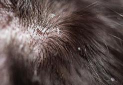 Saçtaki egzamayı geçiren mucize yöntem!