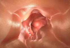 Kalın bağırsak riskini artıran faktörler... En sık görülen üçüncü kanser türünde bu beslenme hatalarına dikkat!