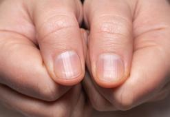 Tırnaklarınızda yatay ve dikey çizgiler varsa dikkat! Birçok hastalığa işaret ediyor olabilir