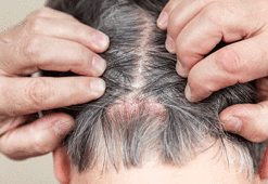 Sakın tüketmeyin! Egzamayı tetikliyor...