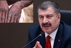Maymun çiçeği virüsü açıklaması! Bakan Koca duyurdu