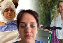 Skuter kazalarında ciddi artış! 5 dakikalık yolculuk için 7 ay tedavi gördü