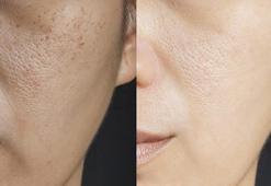 Cilt lekeleriyle mücadele rehberi