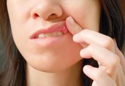 Bu işaretleri görmezden gelmeyin! Bağışıklık sisteminiz çökmüş olabilir