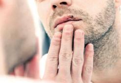 Devrim niteliğinde! Kansere karşı uçuk tedavisi