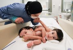 Cezayirli siyam ikizleri Türkiye'de başarıyla ayrıldı: Operasyon için 100 kişilik ekip görev yaptı!