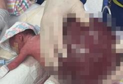 Vücudunun iki katı büyüklüğünde! Bebeği ameliyatla kurtardılar
