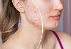 1 haftada sivilce izlerinden kurtulun