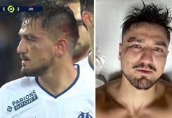 Cengiz Ünder'in kaşı yarıldı, maç sonu paylaştı