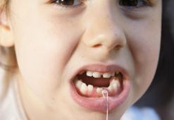 Çocuklarda bruksizm belirtileri