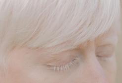 Albino nedir, belirtileri nelerdir? Albino insanların özellikleri nelerdir?