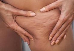 Baş belası selülitleri yok edecek 7 kesin çözüm