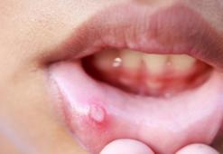 Ağız içi yara deyip geçmeyin! Sonucu ölümcül olabilir