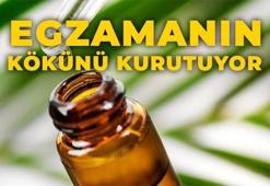 Saç diplerindeki egzamanın kökünü kurutuyor, kaşıntıyı önlüyor! Gece uyumadan önce 1 damla sürmek gerekiyor