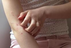 Uzmanından uyarı: Egzama genellikle çocukluk döneminde başlıyor