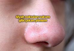 Siyah noktaları birkaç dakikada vakum gibi çekip atıyor! Bebek gibi cilt isteyenlerin vazgeçemediği yöntem