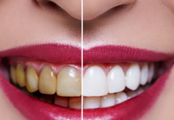 Sararmış dişleri anında beyazlatan tüyo! 1 yemek kaşığını dişlere sürmek yetiyor