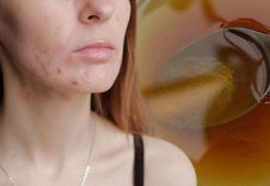 Lekeleri silgi gibi silen formül! Masrafsız cildi ayna gibi yapıyor: 15 gün boyunca geceleri suyla karıştırıp sürün