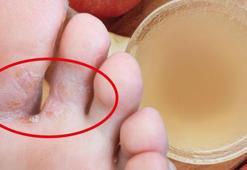 Ayak mantarını söküp atıyor ! Nasır, koku, kaşıntı bırakmıyor: 1 damlası bile kremlerden daha etkili