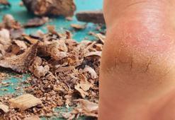 15 dakikada çatlamış topukları onarıyor! Ayak çatlaklarına kesin çözüm, bu yöntem ayakları pamuk gibi yapıyor