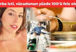 Çorba içti, vücudunun yüzde 100'ü felç oldu! Konserve ürünlerde görülen ölümcül tehdit