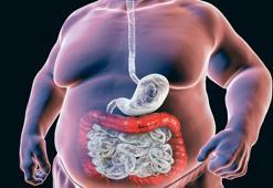 Obezite 32 kanser türüyle bağlantılı