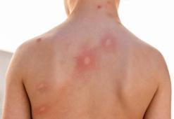 Uzmanından böcek ısırığı uyarısı! Bu izler varsa dikkat!