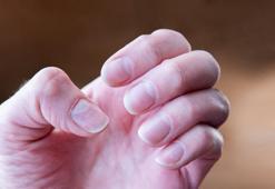 Tırnak dibindeki çizgiler kanserin belirtisi olabilir! Rengi ve büyüklüğüne dikkat