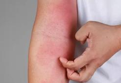 Yaz aylarında böcek ısırıklarına dikkat! Dermatoloji uzmanı önemli uyarılarda bulundu