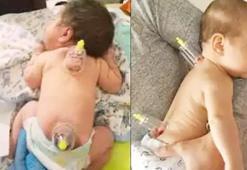 Küçücük bebeklere hacamat yaptırıyorlar! Aman dikkat: Büyük bir riski var