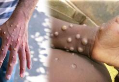 Sağlık Bakanlığı'ndan Maymun Çiçeği (MPOX) rehberi! Nasıl bulaşıyor, semptomlar neler?