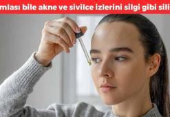 Akne ve sivilce izlerini silgi gibi siliyor! Ciltte ne leke bırakıyor ne de sivilce, pürüzsüz yüzün sırrı meğerse buymuş, her gece yatmadan önce sürün