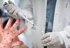 Sağlık Bakanlığı açıkladı: Maymun çiçeği ( MPOX) nasıl bulaşıyor, belirtileri neler?